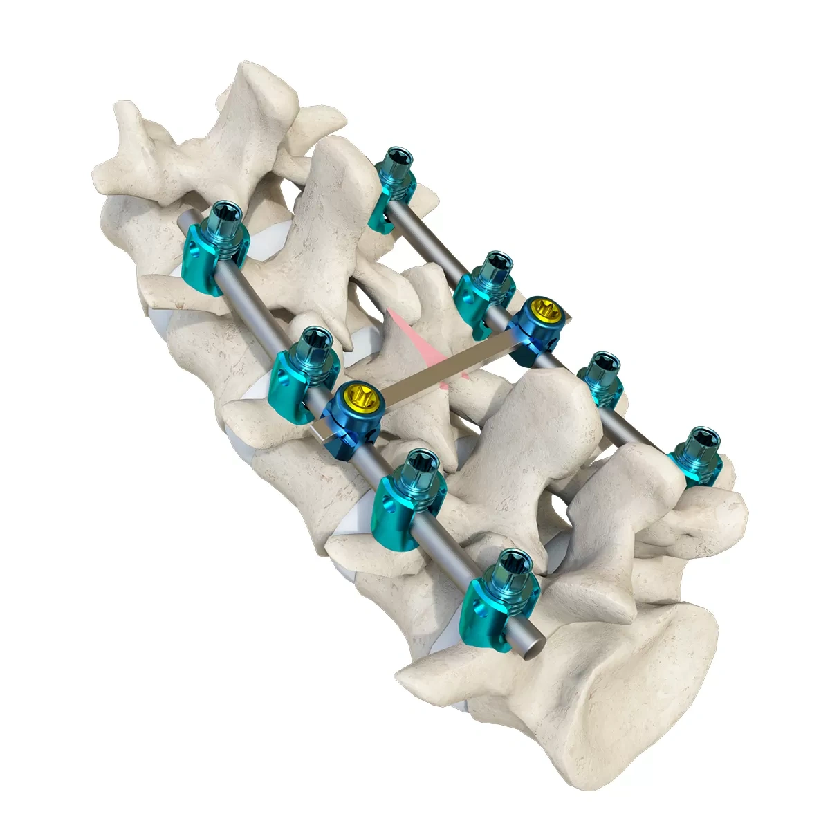 Luna Posterior Thoracolumbar Spinal System,Shinvaunited,Luna Posterior Thoracolumbar Spinal System