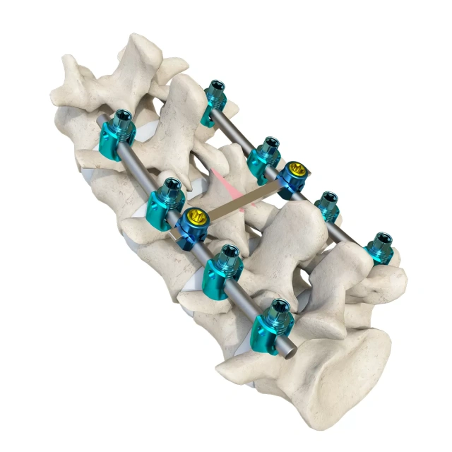 Luna Posterior Thoracolumbar Spinal System,Shinvaunited,Luna Posterior Thoracolumbar Spinal System