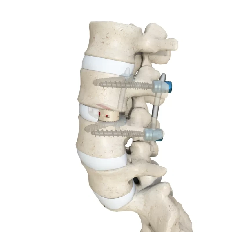 Oblique Lateral Interbody Fusion Cage LF-IV,Shinvaunited,Oblique Lateral Interbody Fusion Cage LF-IV