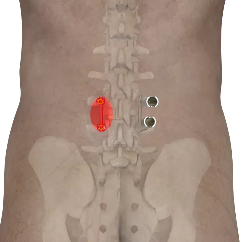 Ti MIS Percutaneous System 5.5,Shinvaunited,Ti MIS Percutaneous System 5.5