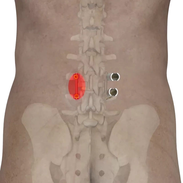 Ti MIS Percutaneous System 5.5,Shinvaunited,Ti MIS Percutaneous System 5.5