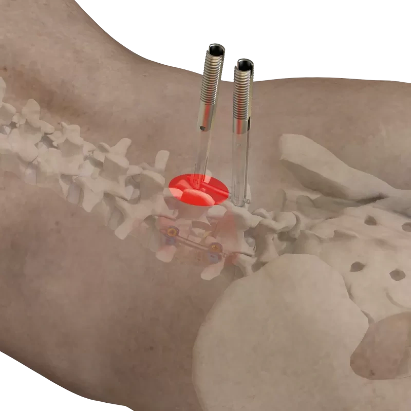 Ti MIS Percutaneous System 5.5,Shinvaunited,Ti MIS Percutaneous System 5.5