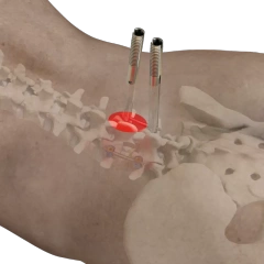 Ti MIS Percutaneous System 5.5,Shinvaunited,Ti MIS Percutaneous System 5.5