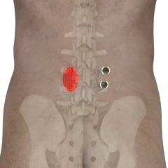 Ti MIS Percutaneous System 6.0,Shinvaunited,Ti MIS Percutaneous System 6.0