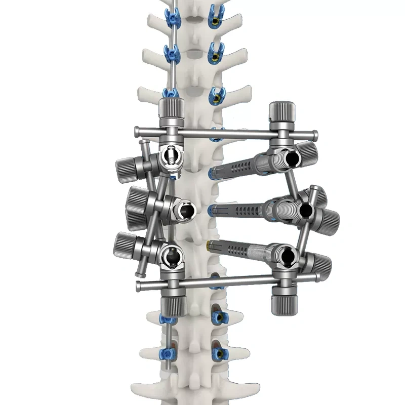 Ti Posterior Rod-Screw for Spinal Deformity (5.5 System),Shinvaunited,Ti Posterior Rod-Screw for Spinal Deformity (5.5 System)