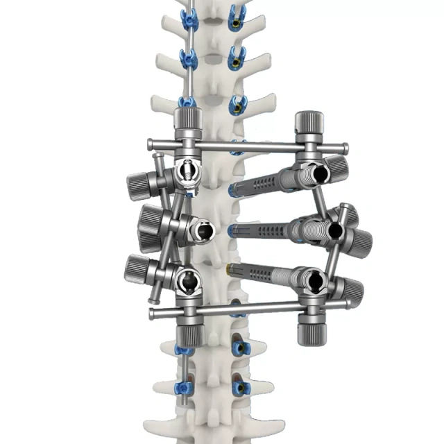 Ti Posterior Rod-Screw for Spinal Deformity (6.0 System),Shinvaunited,Ti Posterior Rod-Screw for Spinal Deformity (6.0 System)