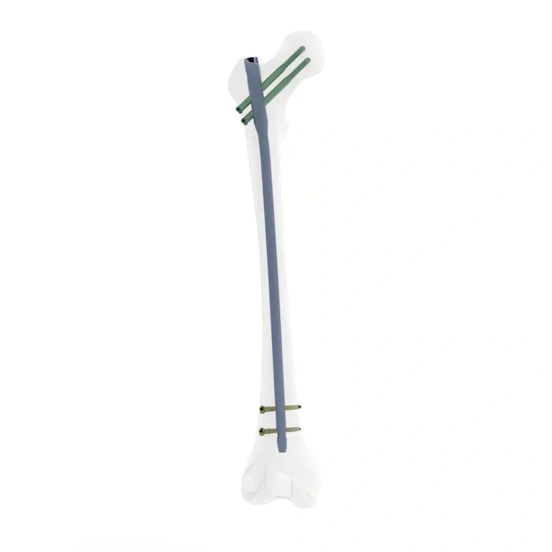 Femoral Reconstruction Nail,Shinvaunited,Femoral Reconstruction Nail