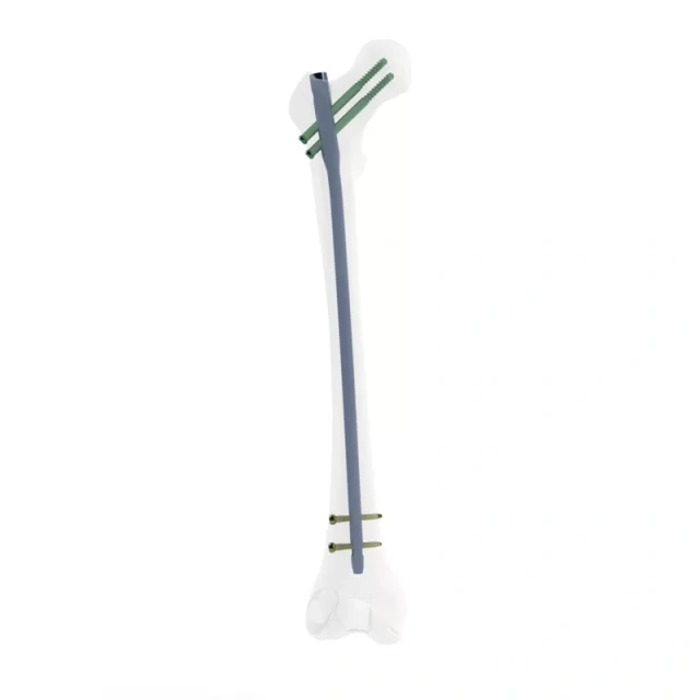 Femoral Reconstruction Nail,Shinvaunited,Femoral Reconstruction Nail