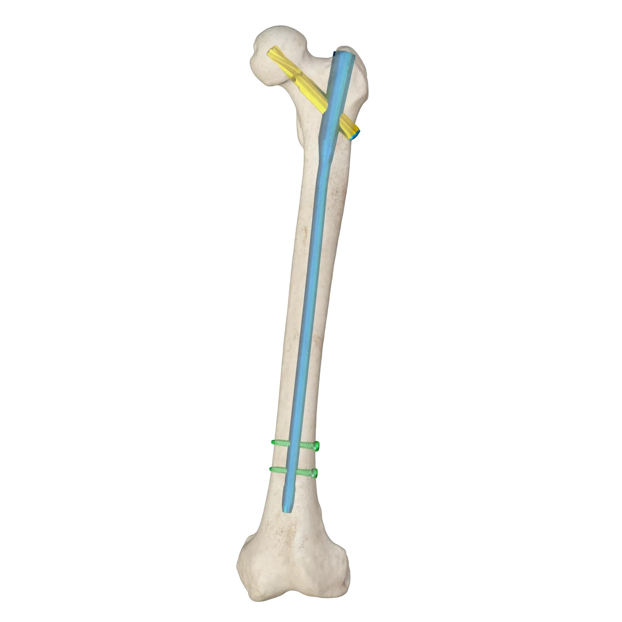 Proximal Femoral Nail Type I – Double Lag Screw,Shinvaunited,Proximal Femoral Nail Type I – Double Lag Screw
