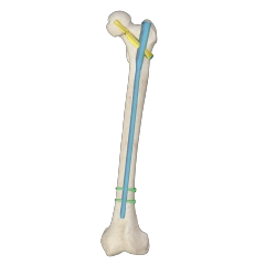 Proximal Femoral Nail Type I – Double Lag Screw,Shinvaunited,Proximal Femoral Nail Type I – Double Lag Screw