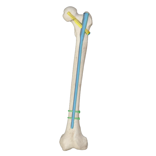 Proximal Femoral Nail Type I – Double Lag Screw,Shinvaunited,Proximal Femoral Nail Type I – Double Lag Screw