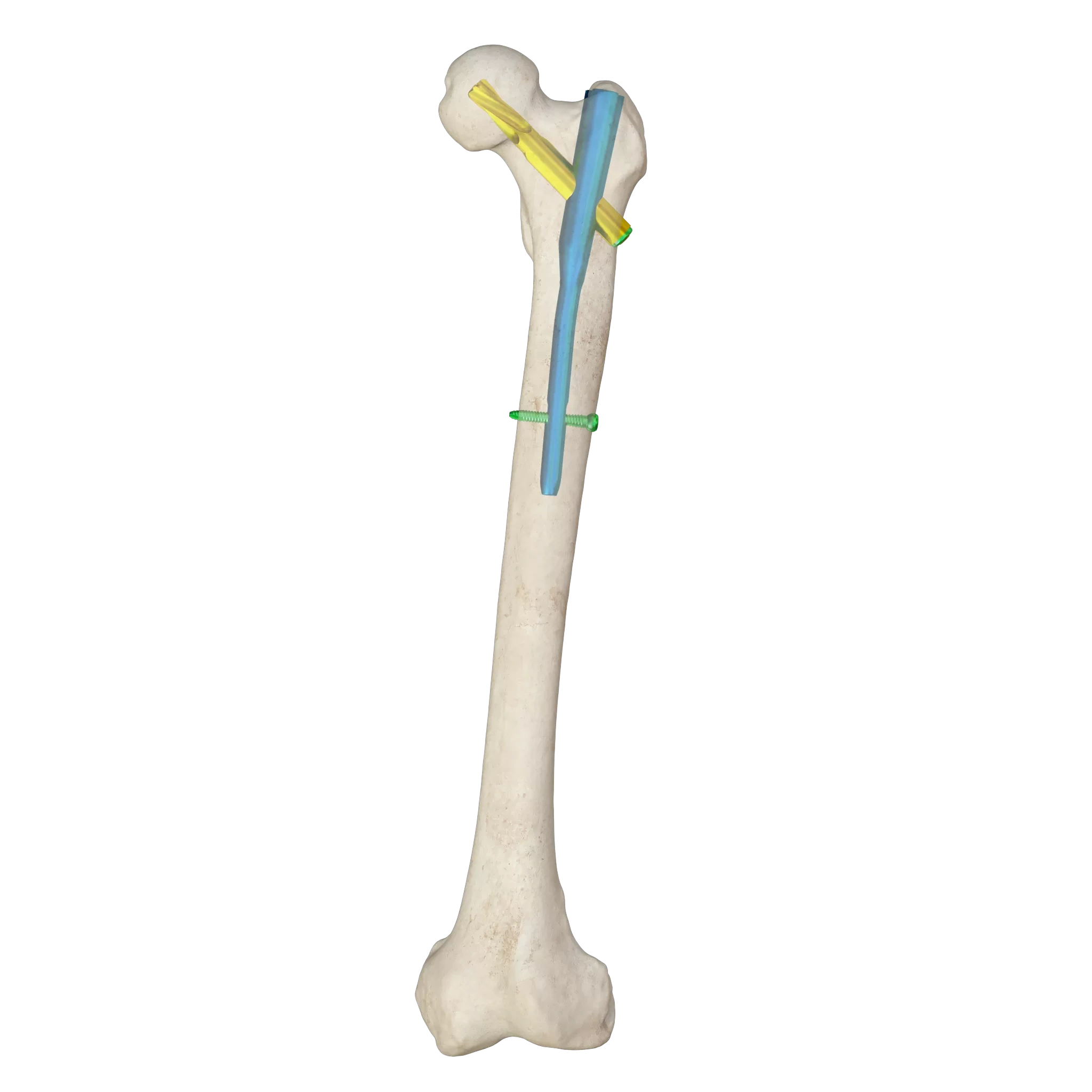 Proximal Femoral Nail Type I – Double Lag Screw,Shinvaunited,Proximal Femoral Nail Type I – Double Lag Screw