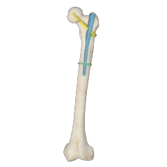 Proximal Femoral Nail Type I – Double Lag Screw,Shinvaunited,Proximal Femoral Nail Type I – Double Lag Screw