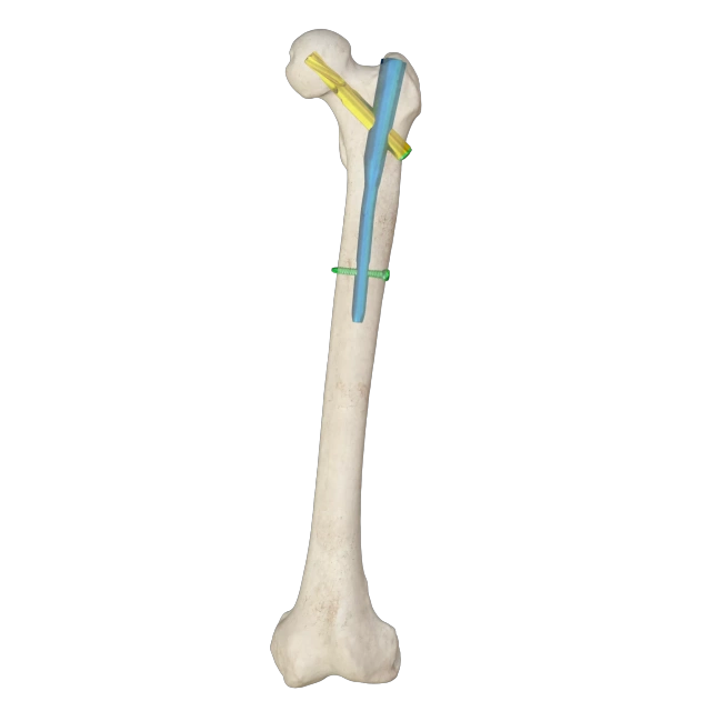Proximal Femoral Nail Type I – Double Lag Screw,Shinvaunited,Proximal Femoral Nail Type I – Double Lag Screw