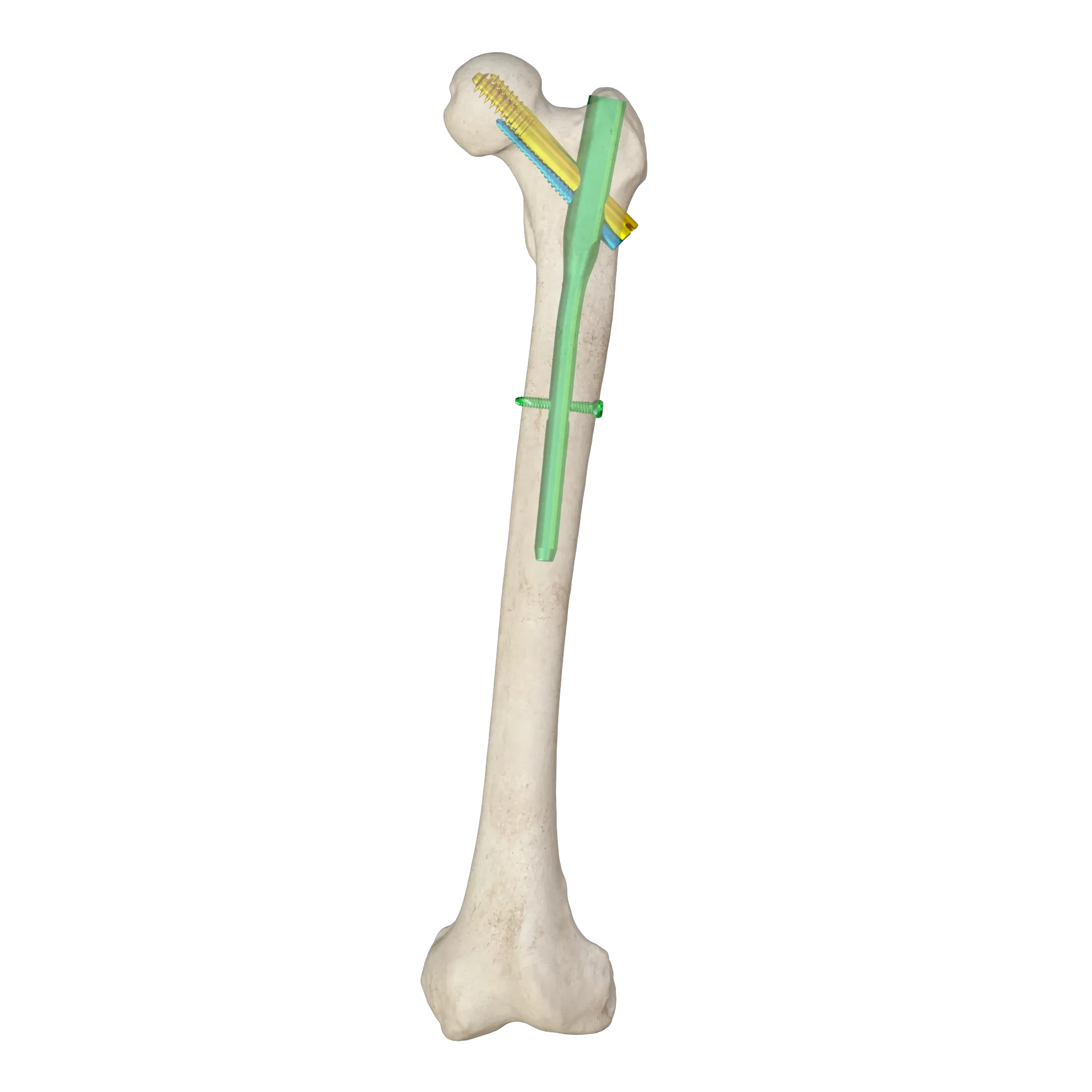 Proximal Femoral Nail Type II – Triple Screw Design (Intertan),Shinvaunited,Proximal Femoral Nail Type II – Triple Screw Design (Intertan)
