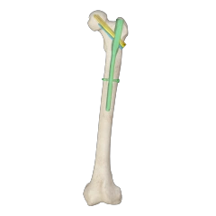 Proximal Femoral Nail Type II – Triple Screw Design (Intertan),Shinvaunited,Proximal Femoral Nail Type II – Triple Screw Design (Intertan)