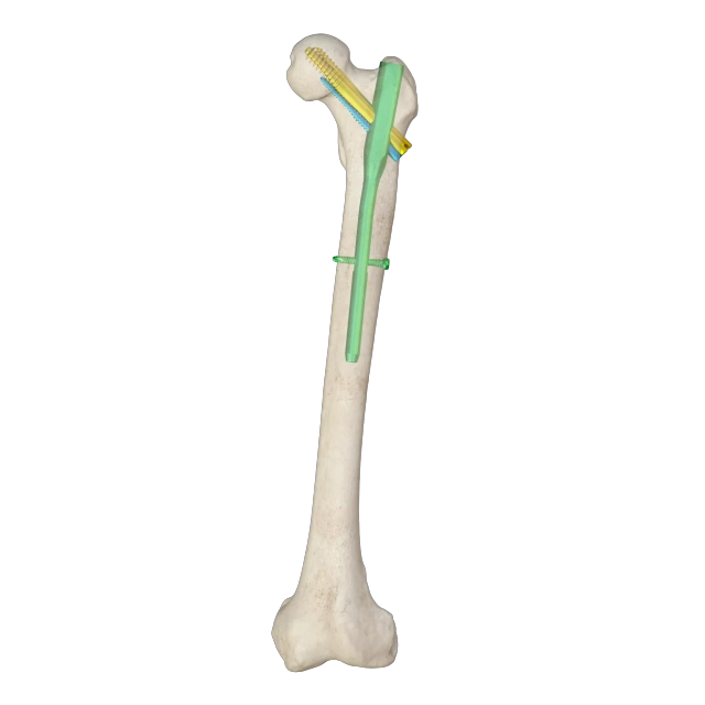 Proximal Femoral Nail Type II – Triple Screw Design (Intertan),Shinvaunited,Proximal Femoral Nail Type II – Triple Screw Design (Intertan)