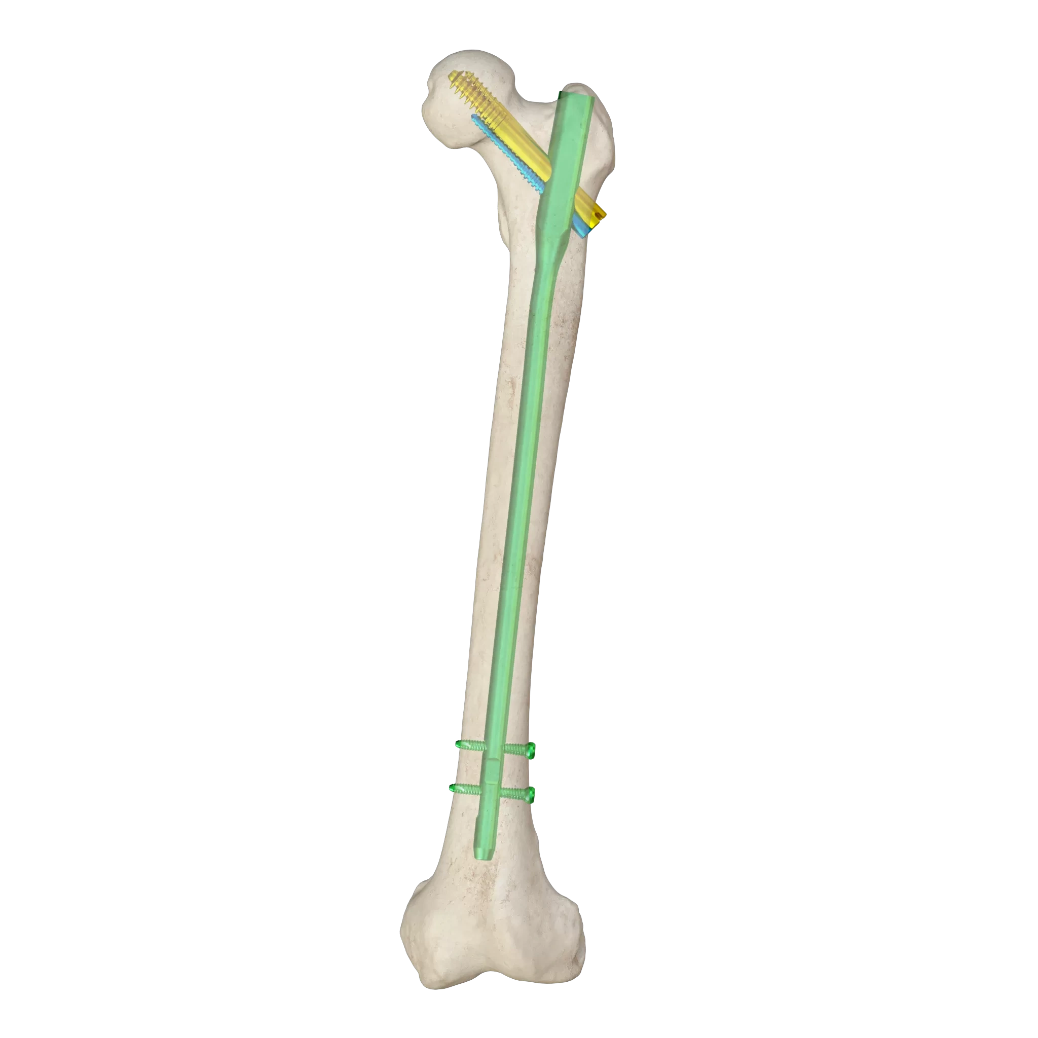 Proximal Femoral Nail Type II – Triple Screw Design (Intertan),Shinvaunited,Proximal Femoral Nail Type II – Triple Screw Design (Intertan)
