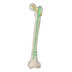 Proximal Femoral Nail Type II – Triple Screw Design (Intertan),Shinvaunited,Proximal Femoral Nail Type II – Triple Screw Design (Intertan)