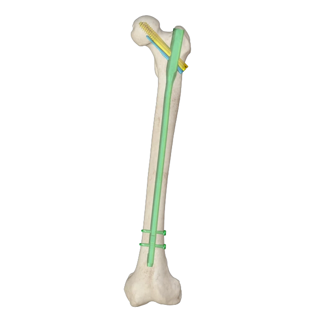 Proximal Femoral Nail Type II – Triple Screw Design (Intertan),Shinvaunited,Proximal Femoral Nail Type II – Triple Screw Design (Intertan)