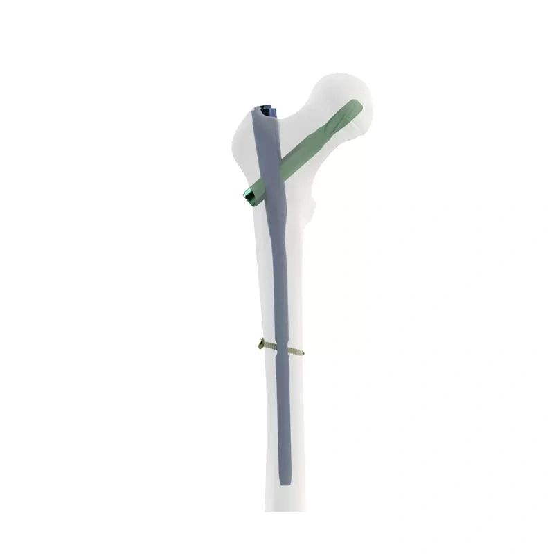Proximal Femoral Nail Type I – Single Lag Screw,Shinvaunited,Proximal Femoral Nail Type I – Single Lag Screw