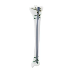 Tibial Intramedullary Nail,Shinvaunited,Tibial Intramedullary Nail