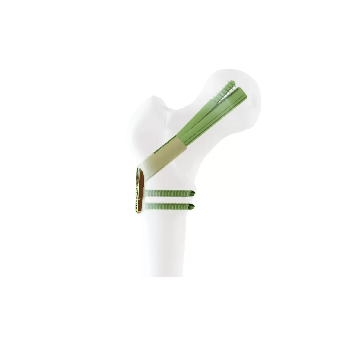 Femoral Neck System-FNS,Shinvaunited,Femoral Neck System-FNS