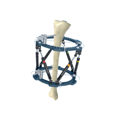 3D External Fixator,Shinvaunited,3D External Fixator