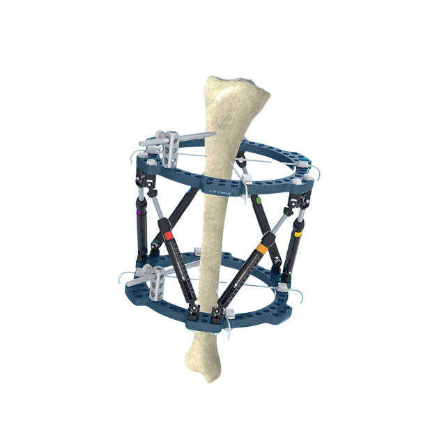 3D External Fixator,Shinvaunited,3D External Fixator