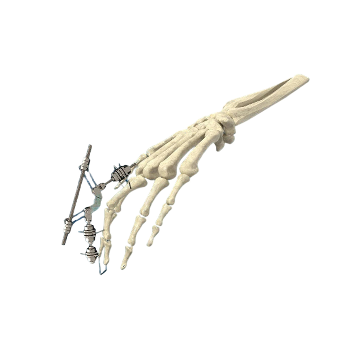 Phalanx External Fixator,Shinvaunited,Phalanx External Fixator