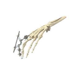 Phalanx External Fixator,Shinvaunited,Phalanx External Fixator