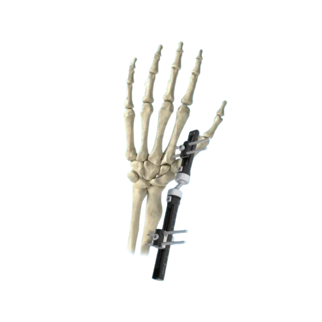 Wrist External Fixator,Shinvaunited,Wrist External Fixator