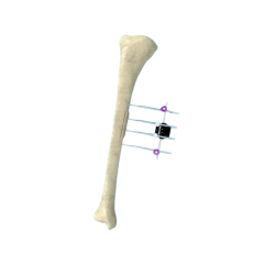 Transverse Bone Transport External Fixator,Shinvaunited,Transverse Bone Transport External Fixator
