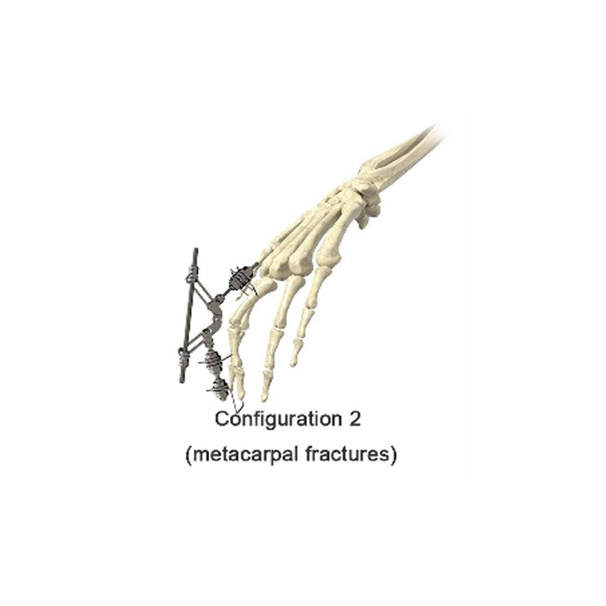 Phalanx External Fixator,Shinvaunited,Phalanx External Fixator