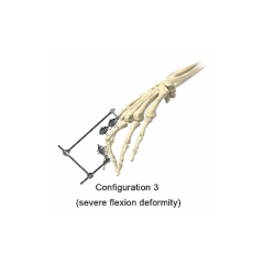 Phalanx External Fixator,Shinvaunited,Phalanx External Fixator