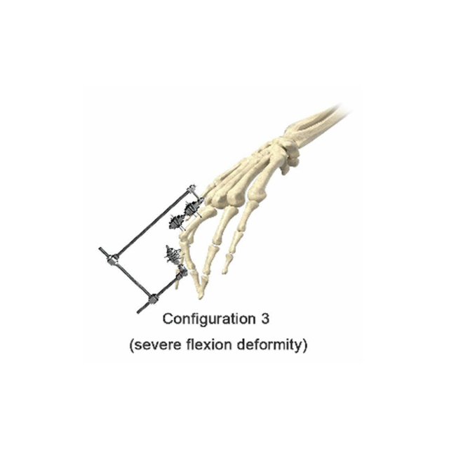 Phalanx External Fixator,Shinvaunited,Phalanx External Fixator