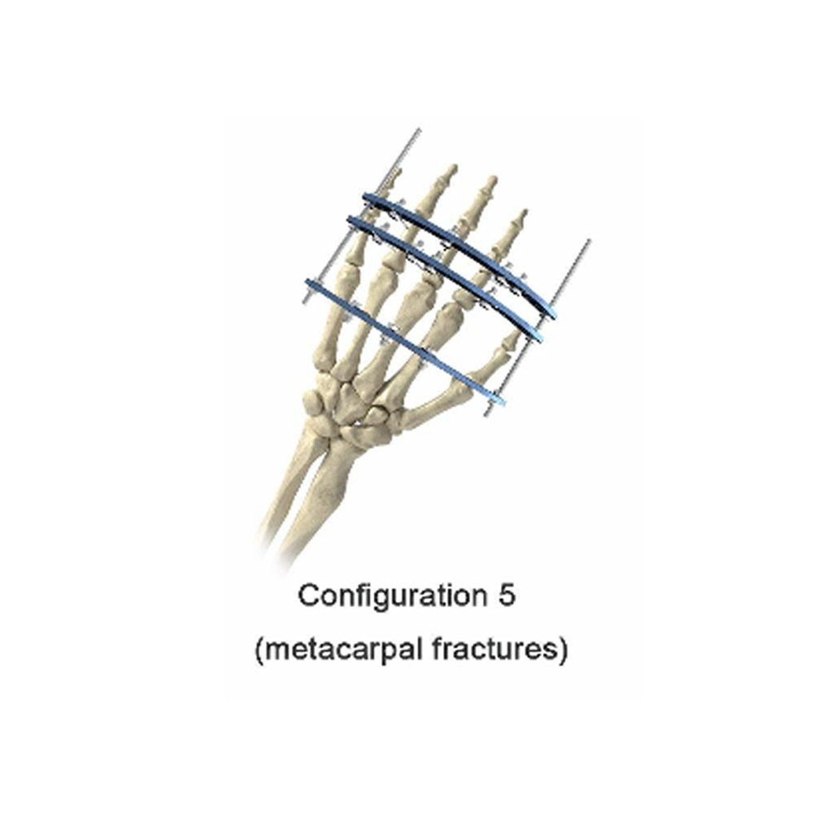Phalanx External Fixator,Shinvaunited,Phalanx External Fixator