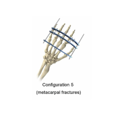 Phalanx External Fixator,Shinvaunited,Phalanx External Fixator