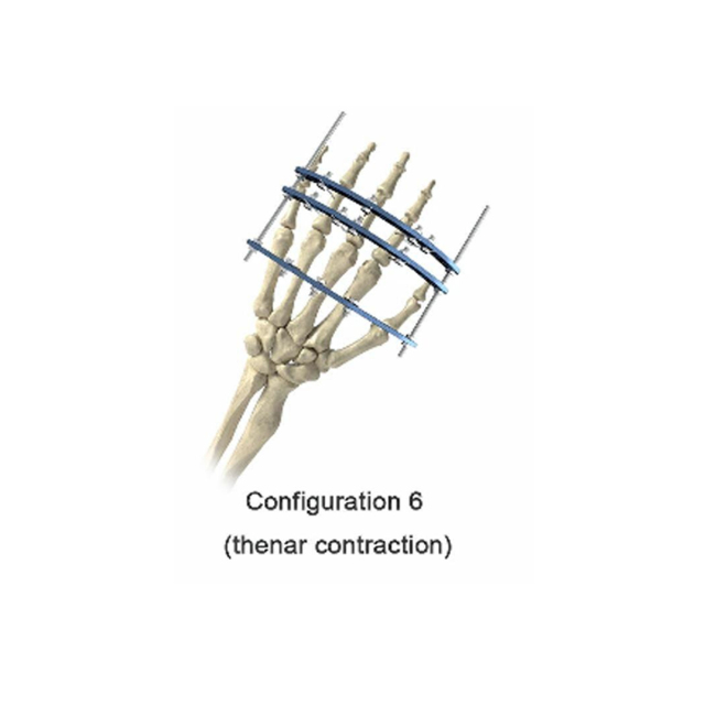 Phalanx External Fixator,Shinvaunited,Phalanx External Fixator