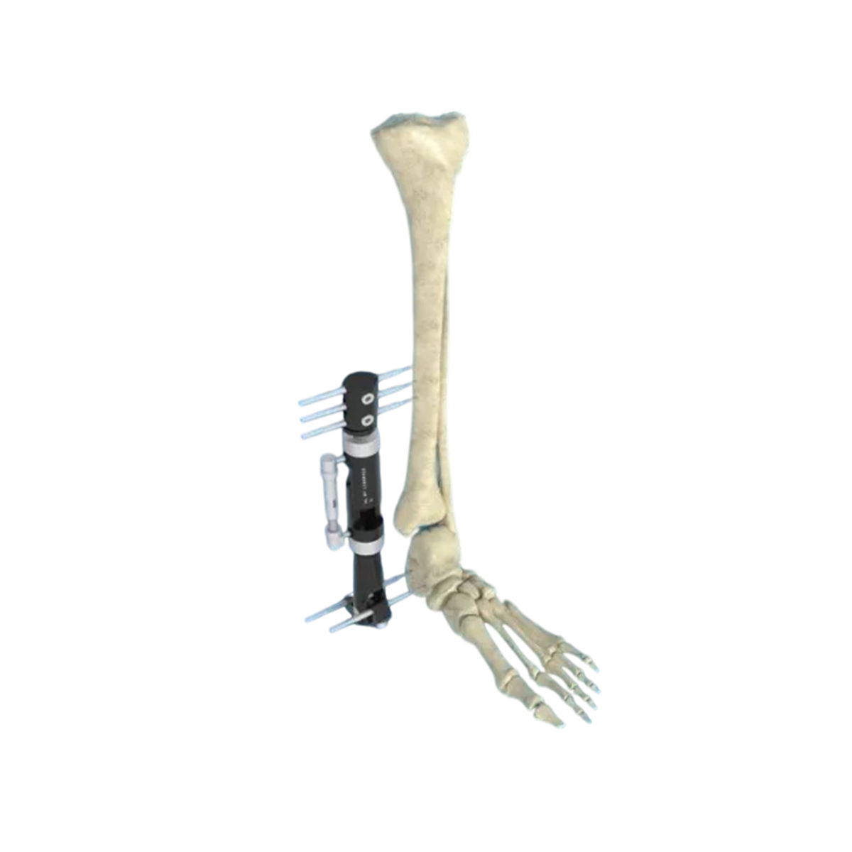 Lateral External Fixator,Shinvaunited,Lateral External Fixator