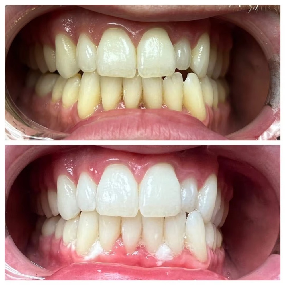 Professional 5ml Dental Clinic Use Result Guarantee 35% Hydrogen Peroxide Teeth Whitening Gel  Dual Barrel with Mixture Tip