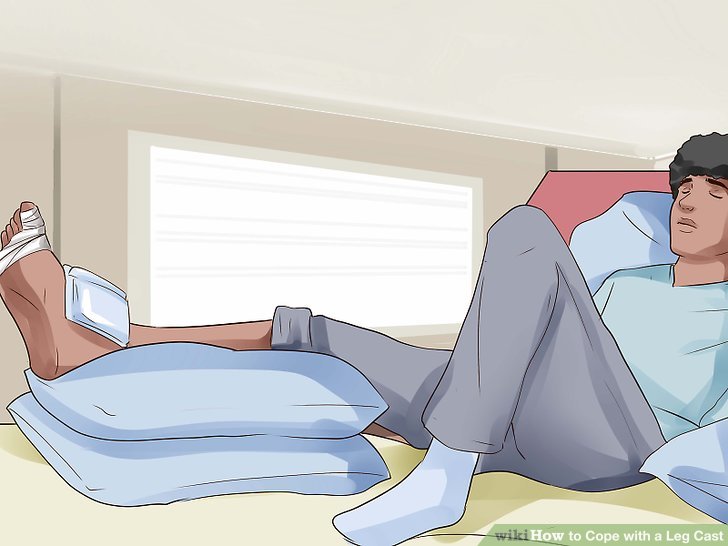 How to Cope with a Leg Cast