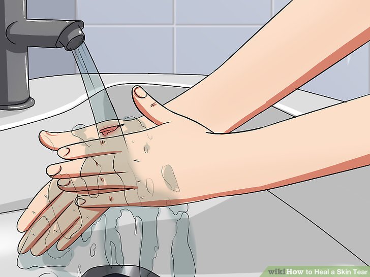 How to Heal a Skin Tear