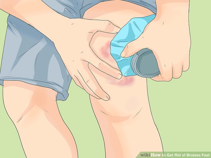 How to Get Rid of Bruises Fast