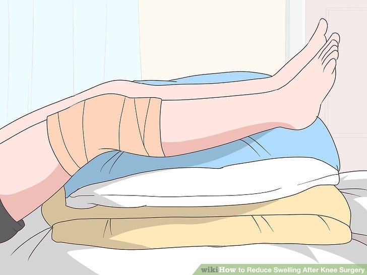 How to Reduce Swelling After Knee Surgery
